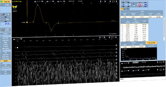 EMG et MUP à l’aiguille